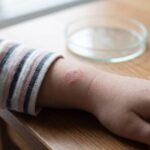 Losing Skin Enzyme KLK5 Worsens Eczema and Disrupts Bacteria in Mice
